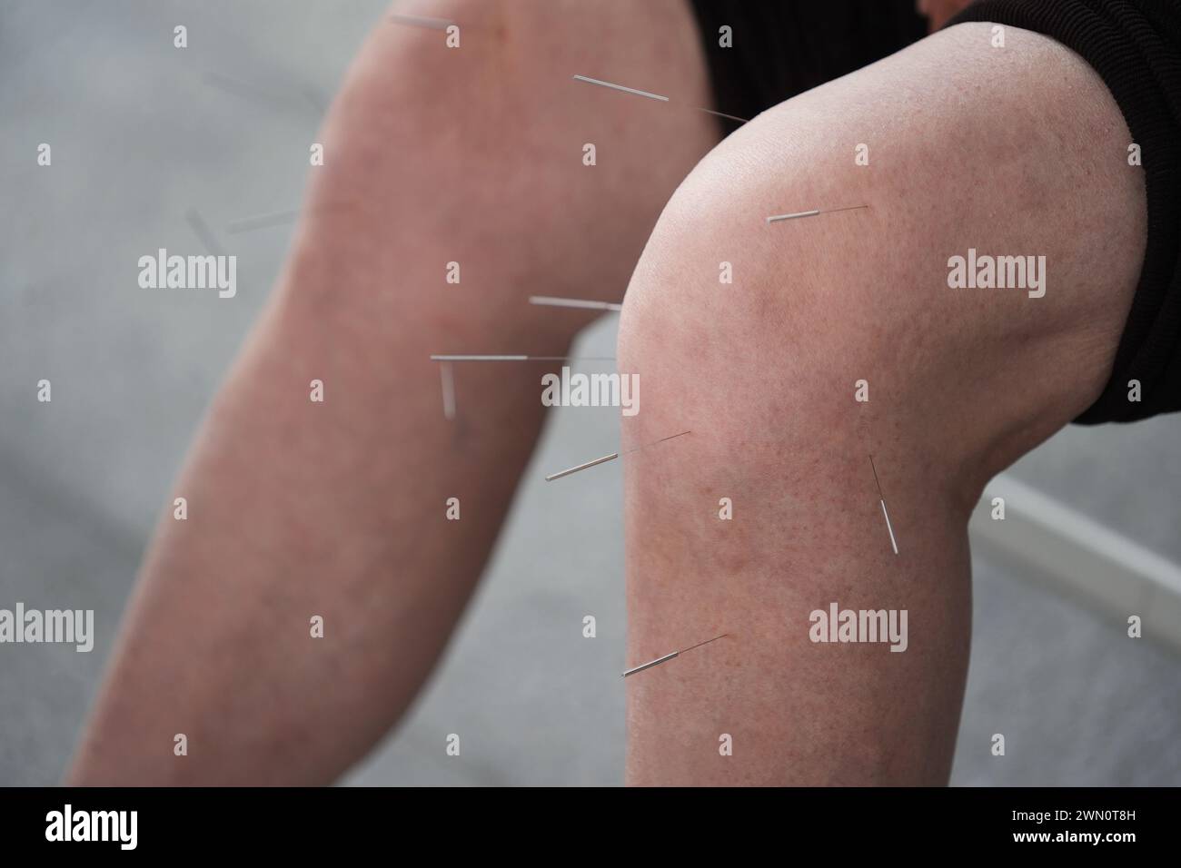 Close-up of a person receiving acupuncture treatment in a medical practice Stock Photo