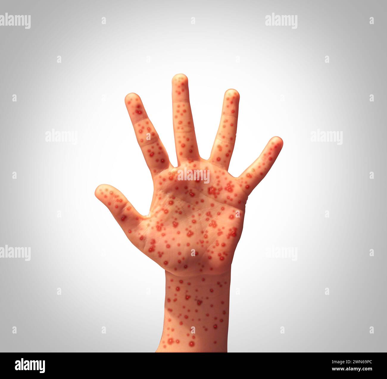 Measles Disease Concept as a Hand with a viral illness infection spread as Koplik spots on the skin and the dangers of spreading the contagious virus Stock Photo