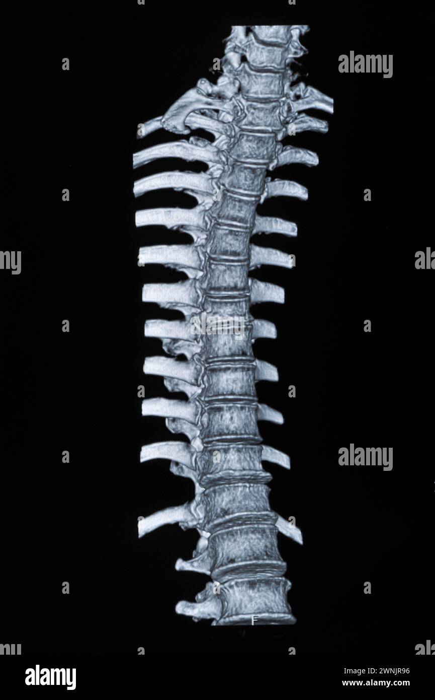 Spinal mri images Stock Photo