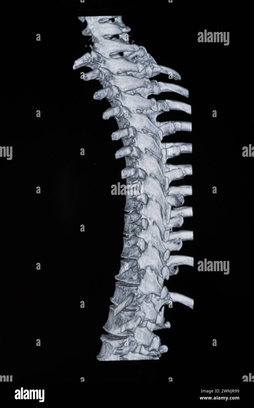 Spinal mri images Stock Photo