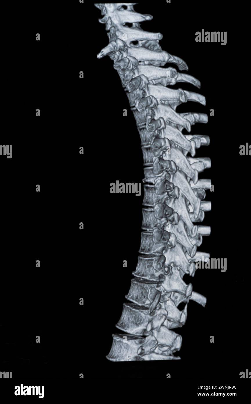 Mri of the cervical spine hi-res stock photography and images - Alamy