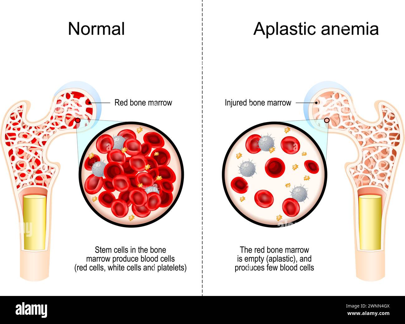 Aplastic anemia. Cross section of a femur with Bone marrow failure. Close-up of a blood cells. Stem cells in the bone marrow produce red blood cells, Stock Vector