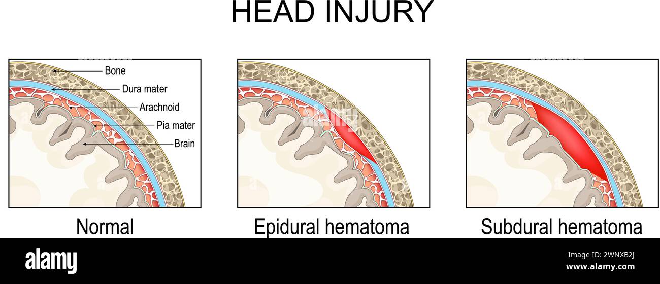 Epidural hematoma and Subdural hematoma. Traumatic brain injury. Cross section of a human skull. Close-up of a brain Meninges. Pia mater, Dura matter, Stock Vector