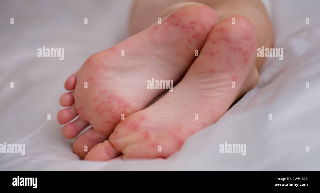 Painful rash red spots blisters on child leg Stock Photo