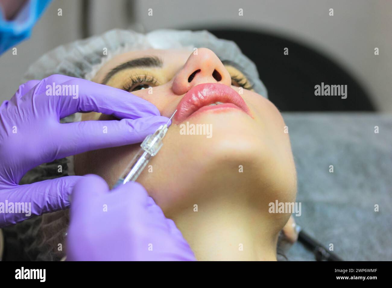 Lip augmentation procedure. A beautiful patient woman getting filler ...