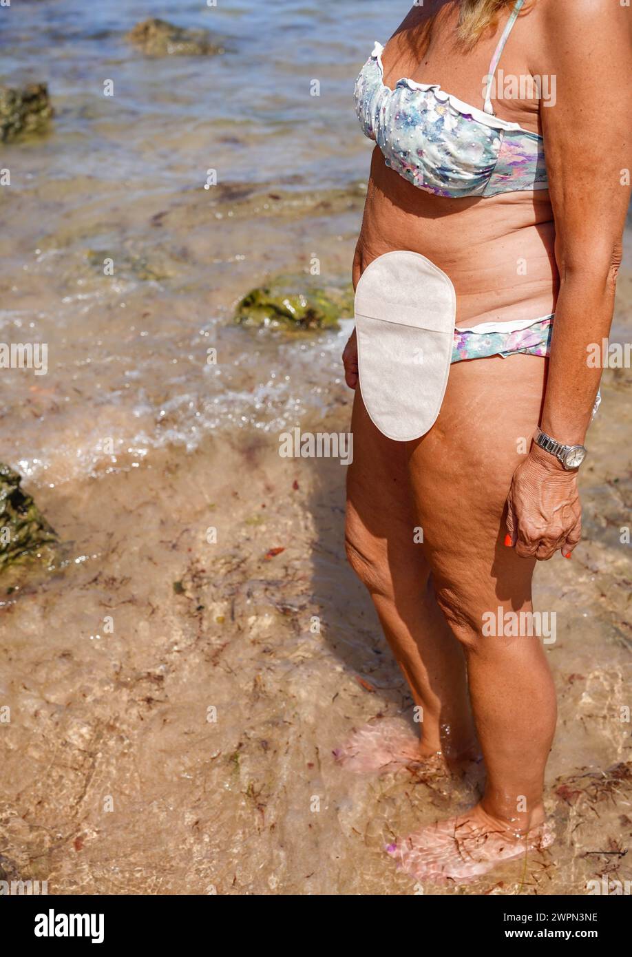 Stoma bag hi-res stock photography and images - Alamy