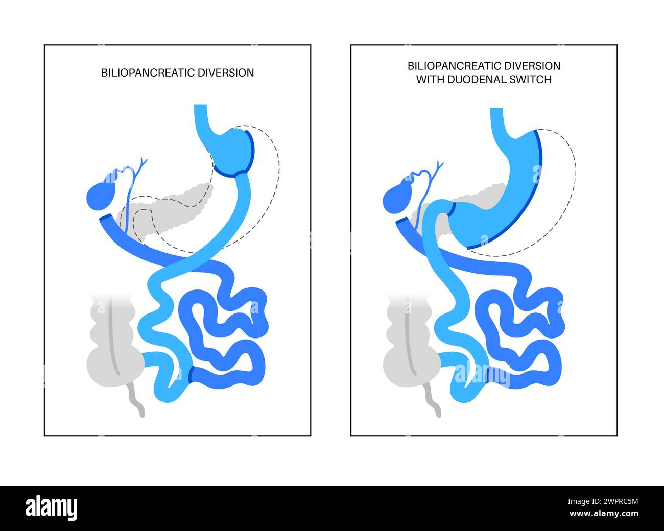 Biliopancreatic diversion (BPD) with duodenal switch, illustration. BPD