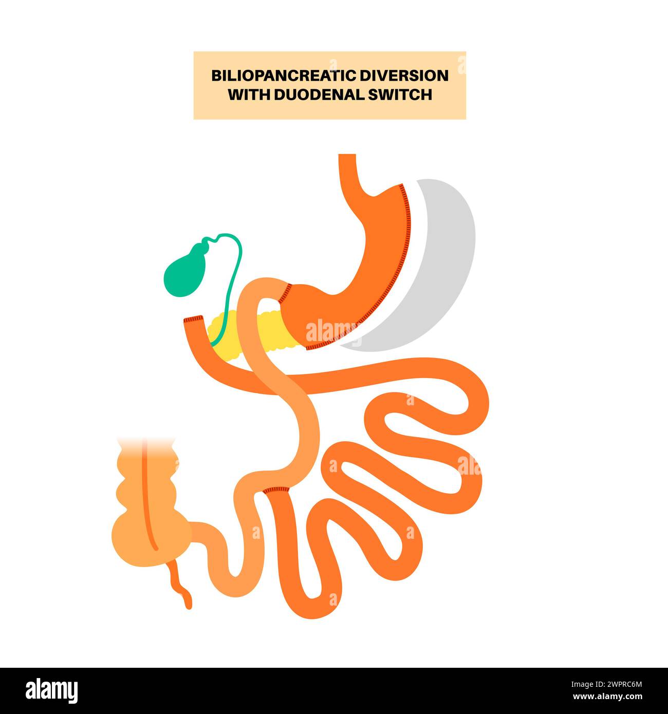 Biliopancreatic diversion (BPD) with duodenal switch, illustration ...