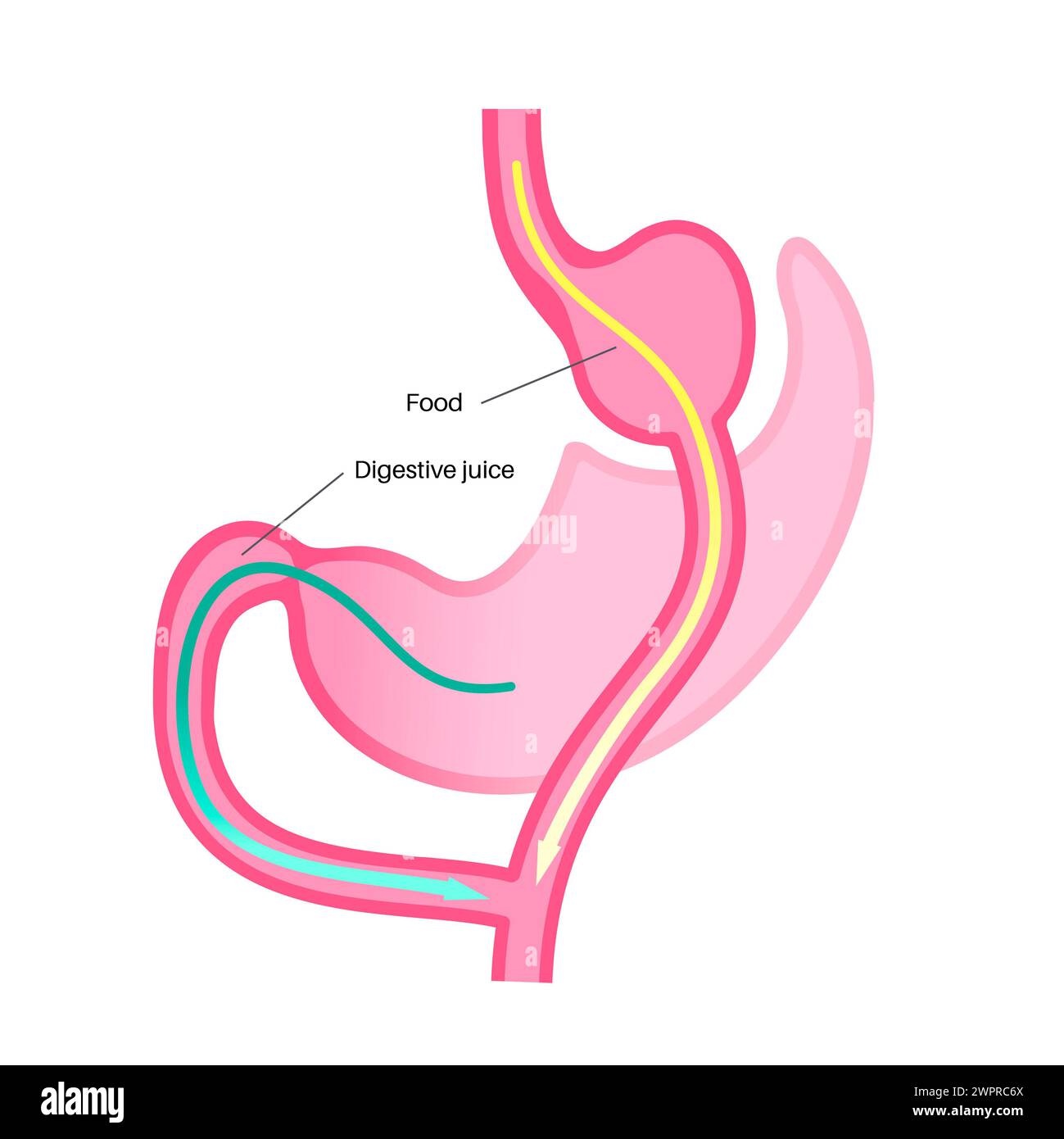 Gastric bypass surgery, illustration Stock Photo - Alamy