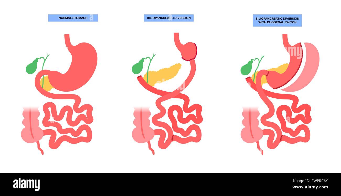 Biliopancreatic diversion (BPD) with duodenal switch, illustration. BPD ...