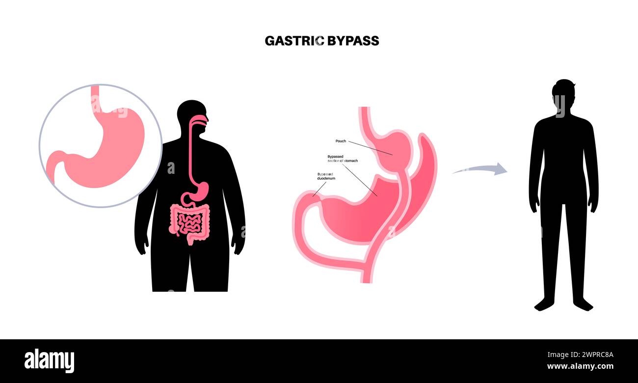 Gastric bypass surgery, illustration Stock Photo - Alamy