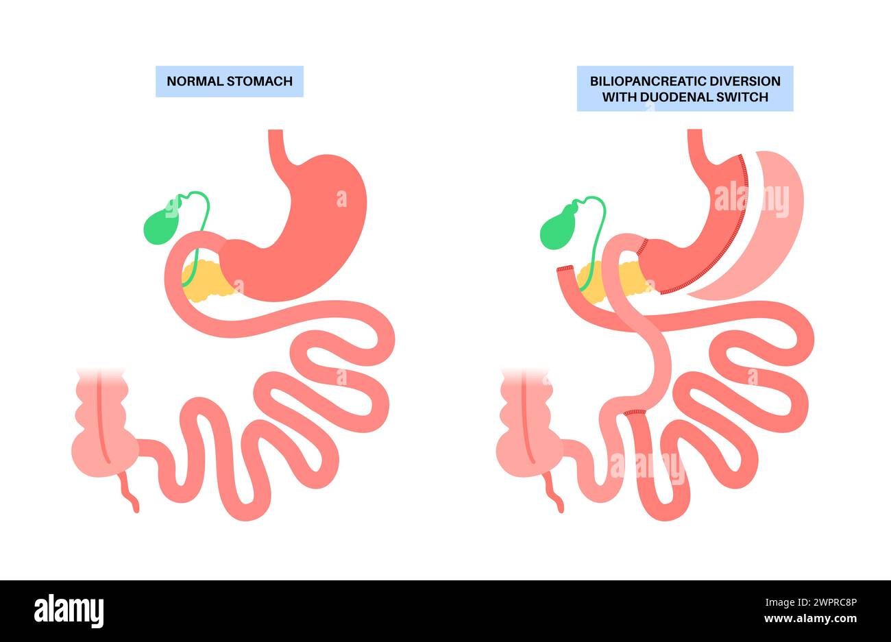 Biliopancreatic diversion (BPD) with duodenal switch, illustration. BPD