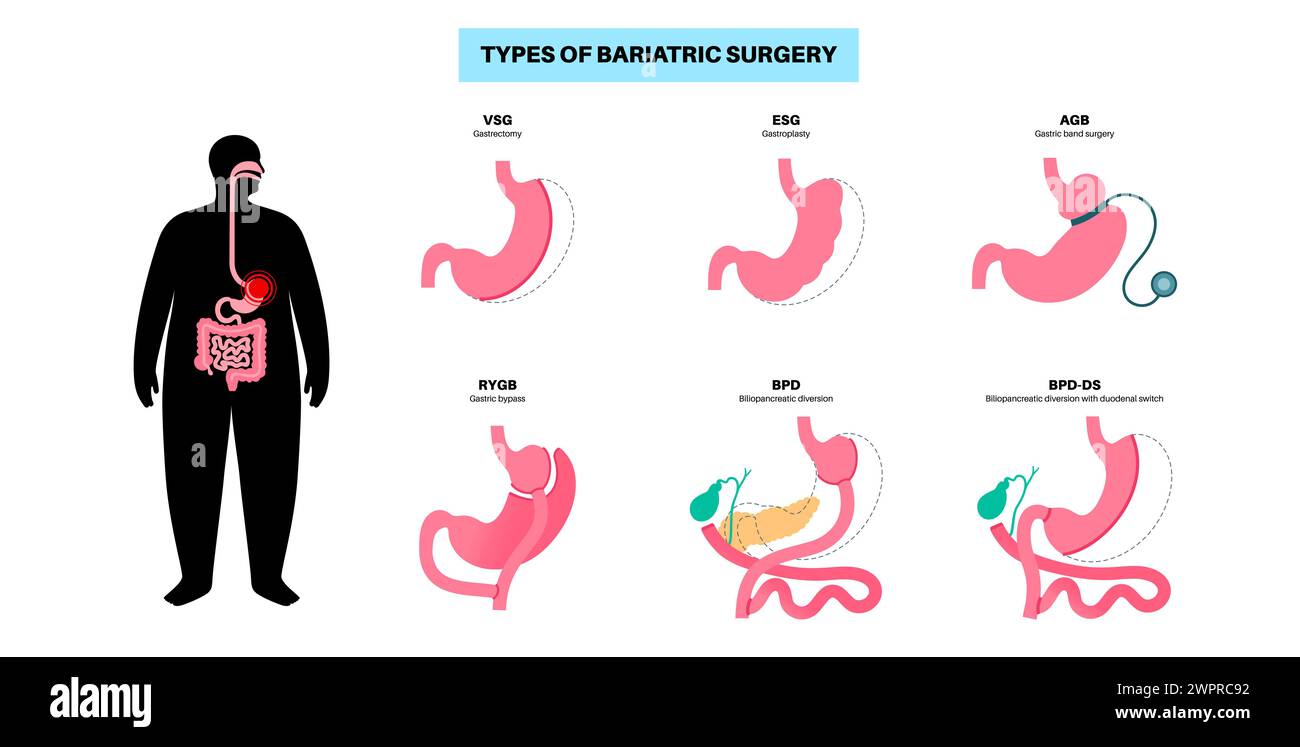 Types of bariatric surgery illustration Healthy stomach and internal