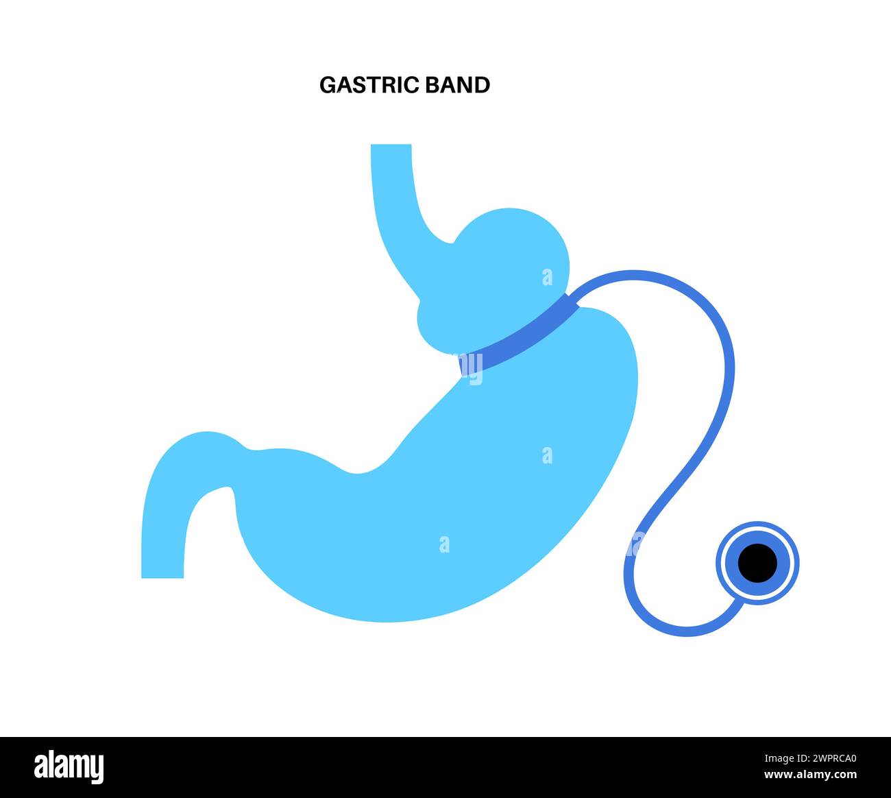 Gastric band medical procedure, illustration. Adjustable gastric