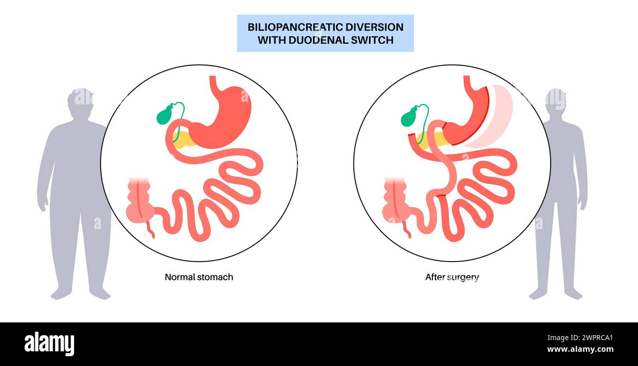 Biliopancreatic diversion (BPD) with duodenal switch, illustration. BPD ...