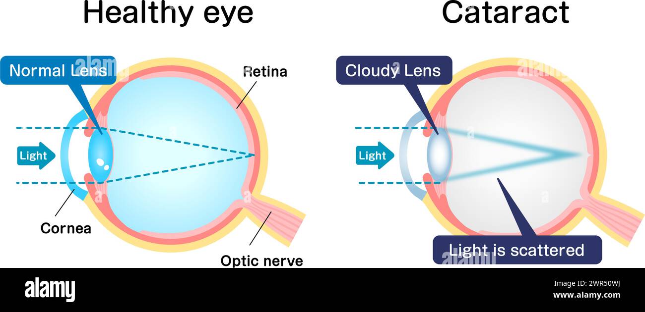 Causes and mechanism of cataract vector illustration Stock Vector