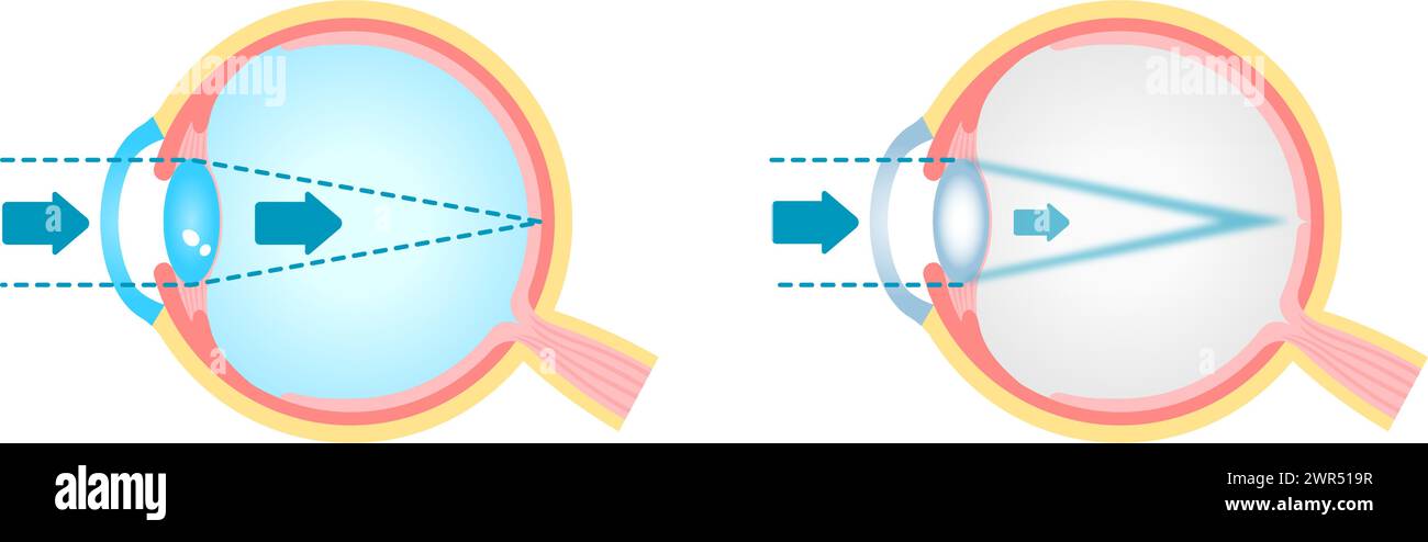Causes and mechanism of cataract vector illustration Stock Vector