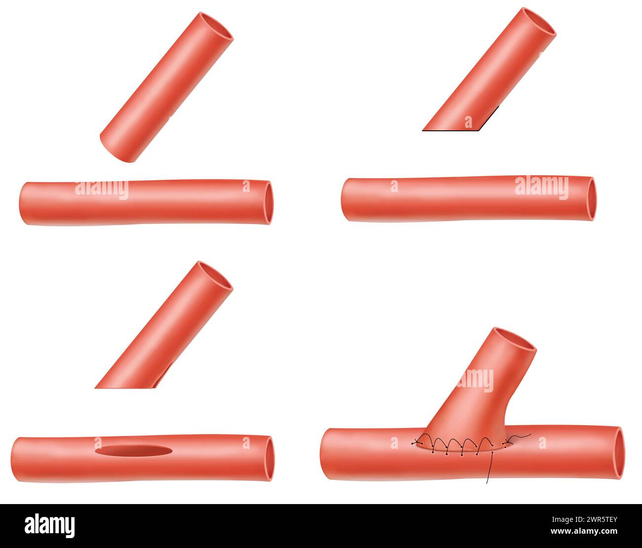 Anastomosis hi-res stock photography and images - Alamy