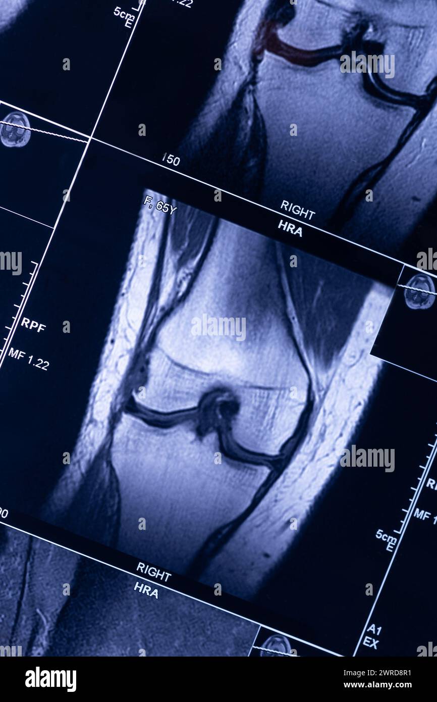 Xray MRI examination magnetic resonance images showing real fracture knee after injury blue tone Stock Photo