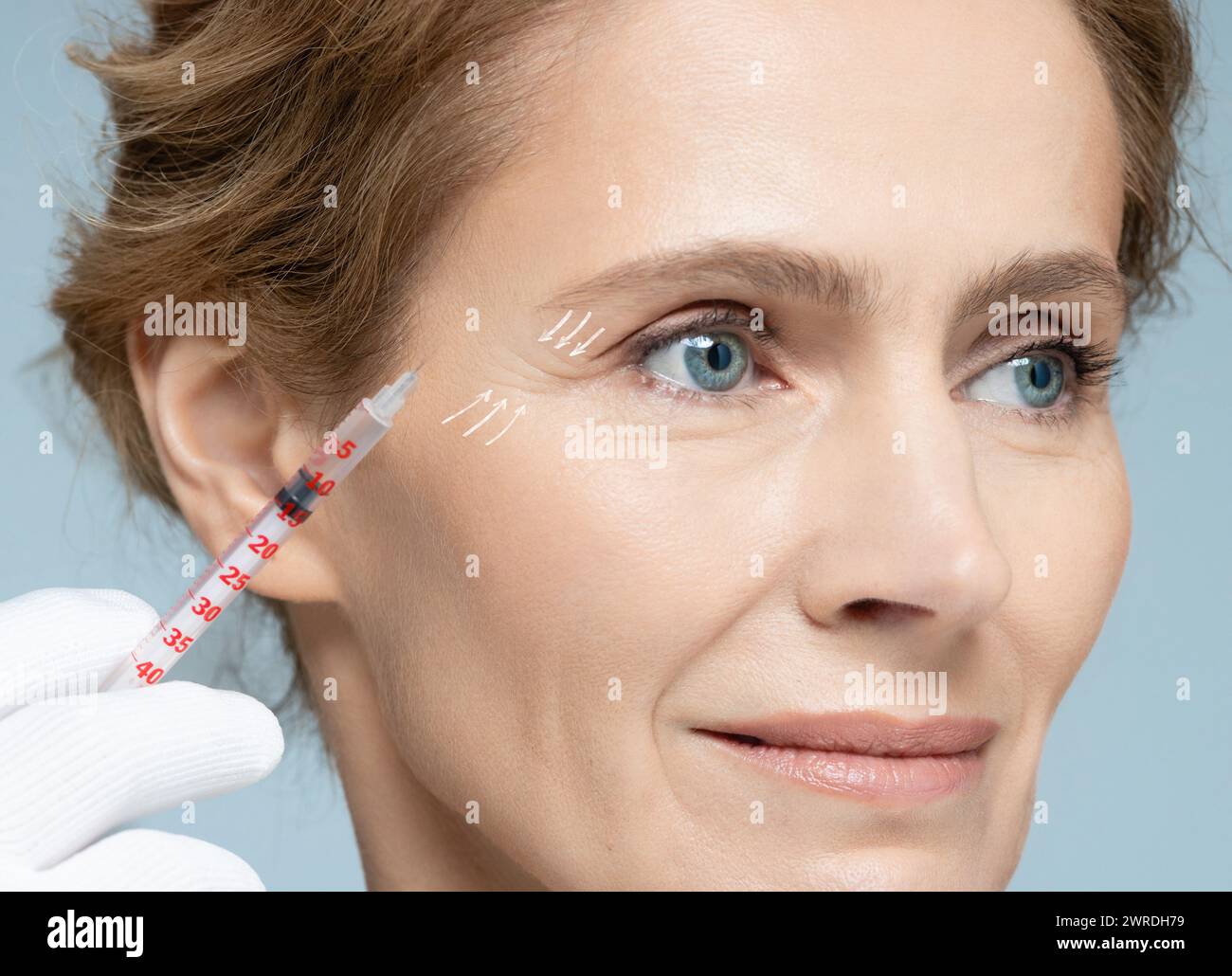 Biorevitalization procedure. Middleaged woman while beauty injections with hyaluronic acid for