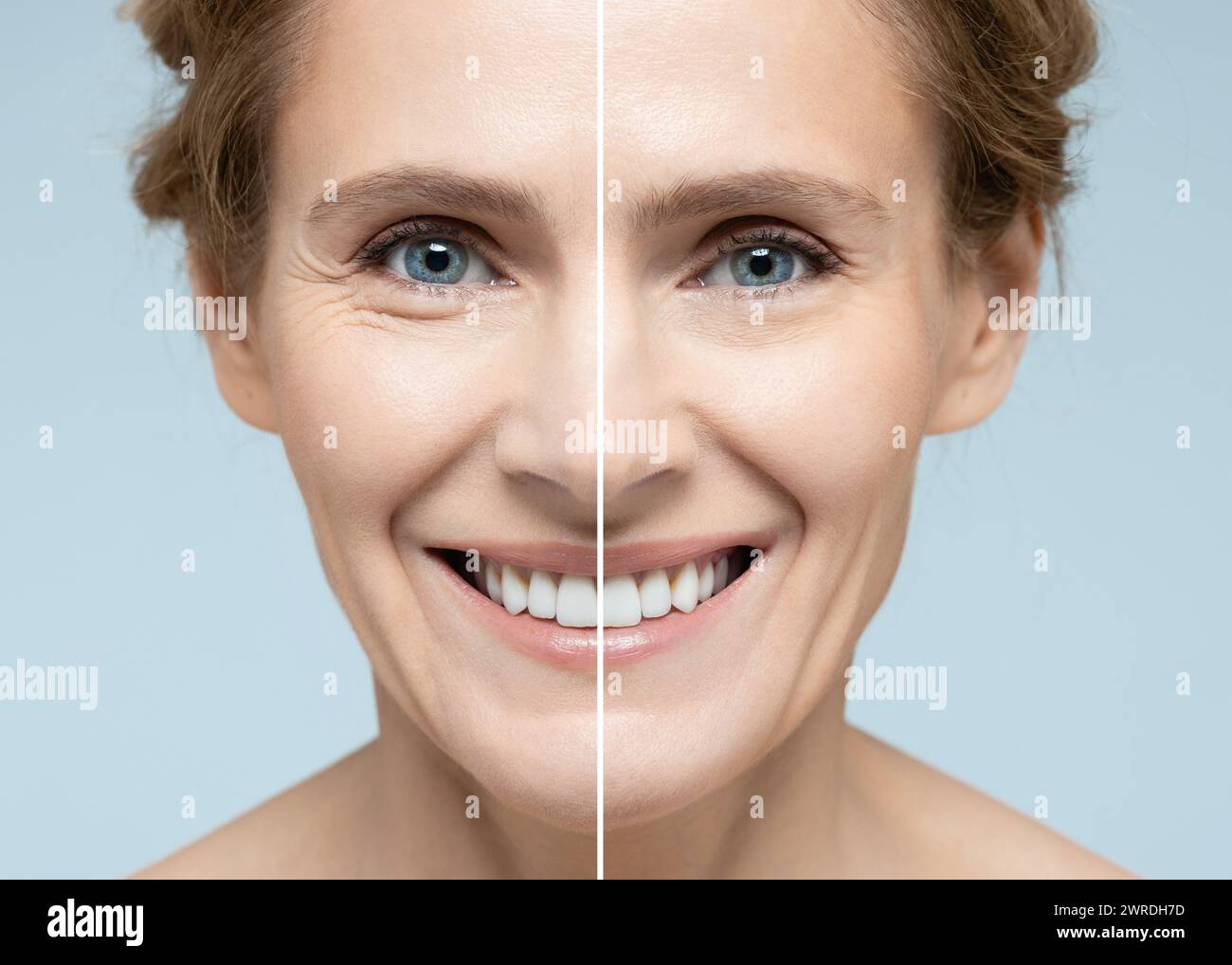 Woman's face before and after skin tightening and anti-aging procedures. Remove of wrinkles, nasolabial folds, skin rejuvenation procedure Stock Photo