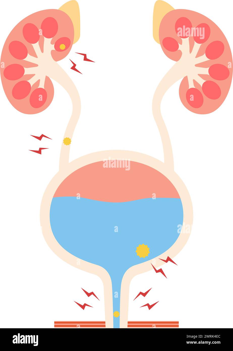 Medical illustration of urinary tract stones, kidney stones, ureteral ...