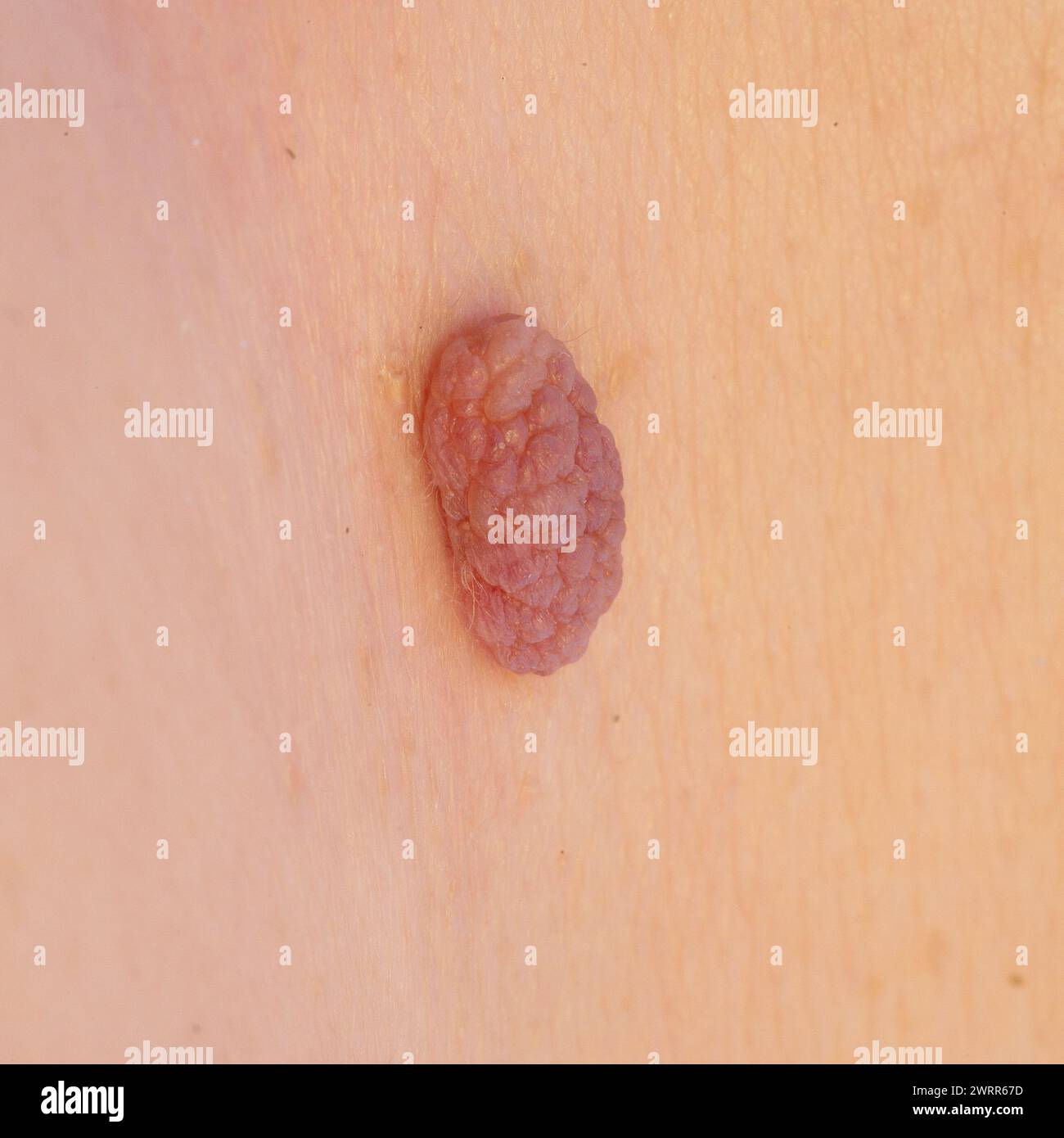 Detailed close-up view of a benign skin tumor on clear skin Stock Photo