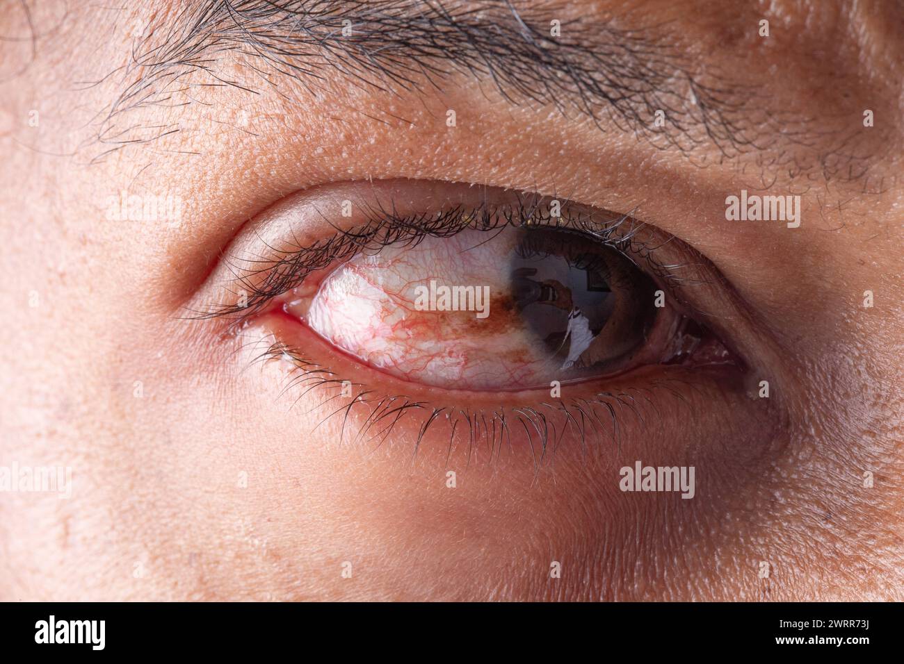 Detailed image of an eye condition known as Pterygium Stock Photo