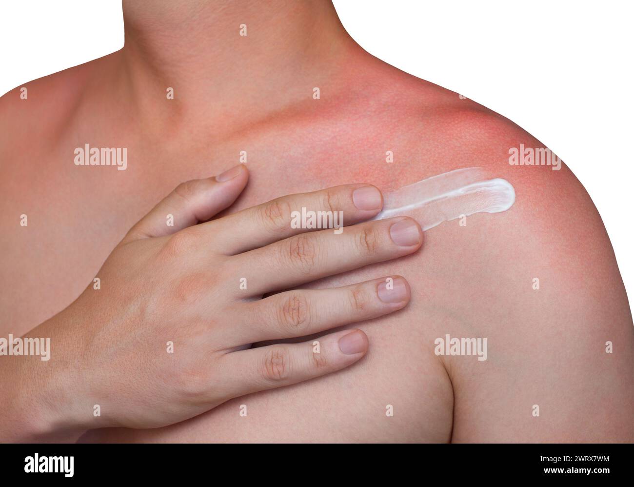 A man with reddened, itchy skin after sunburn applies a cream on the shoulder. Skin care and