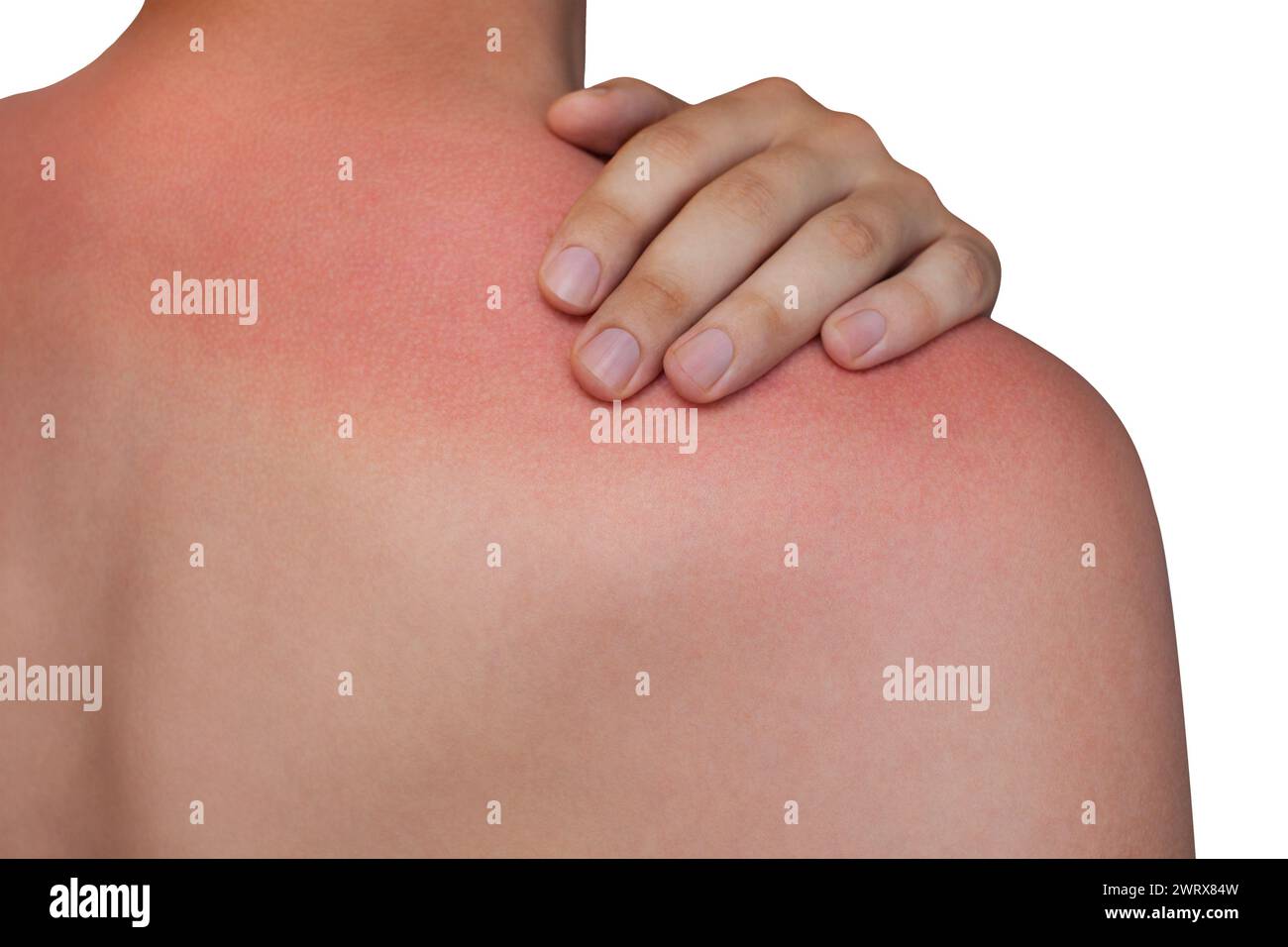 A man with reddened, itchy skin after sunburn on white isolated background. Skin care and