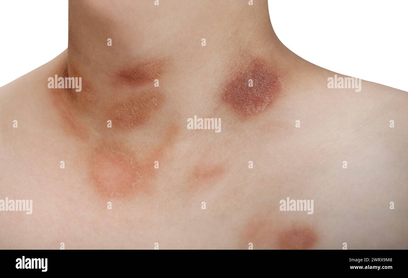 Chest Rash Book Pic Why Do I Have A Rash On My Neck And Chest