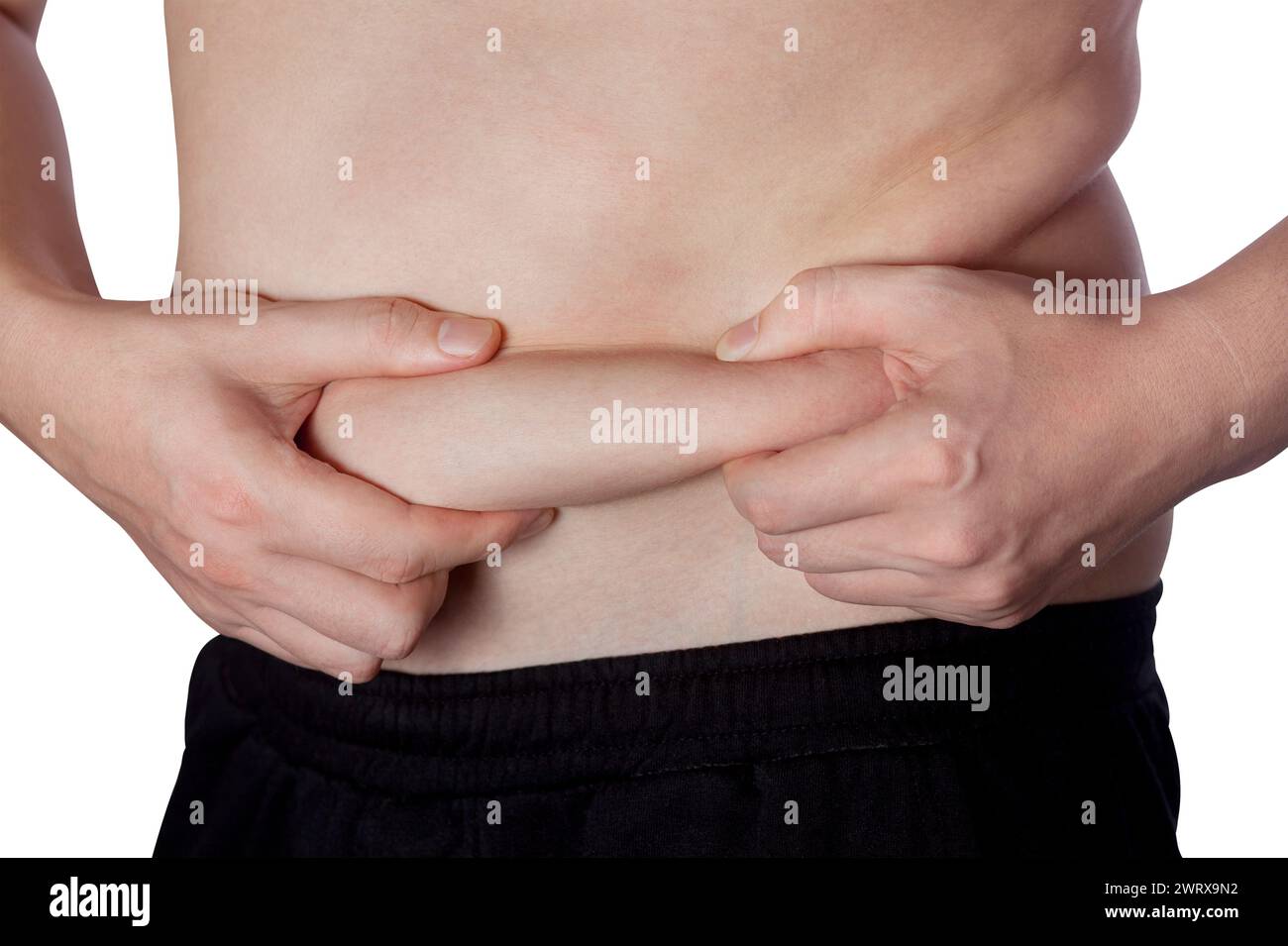 A fat man shows fat deposits on his stomach. Reduction of overweight and obesity treatment. Healthy lifestyle. Stock Photo