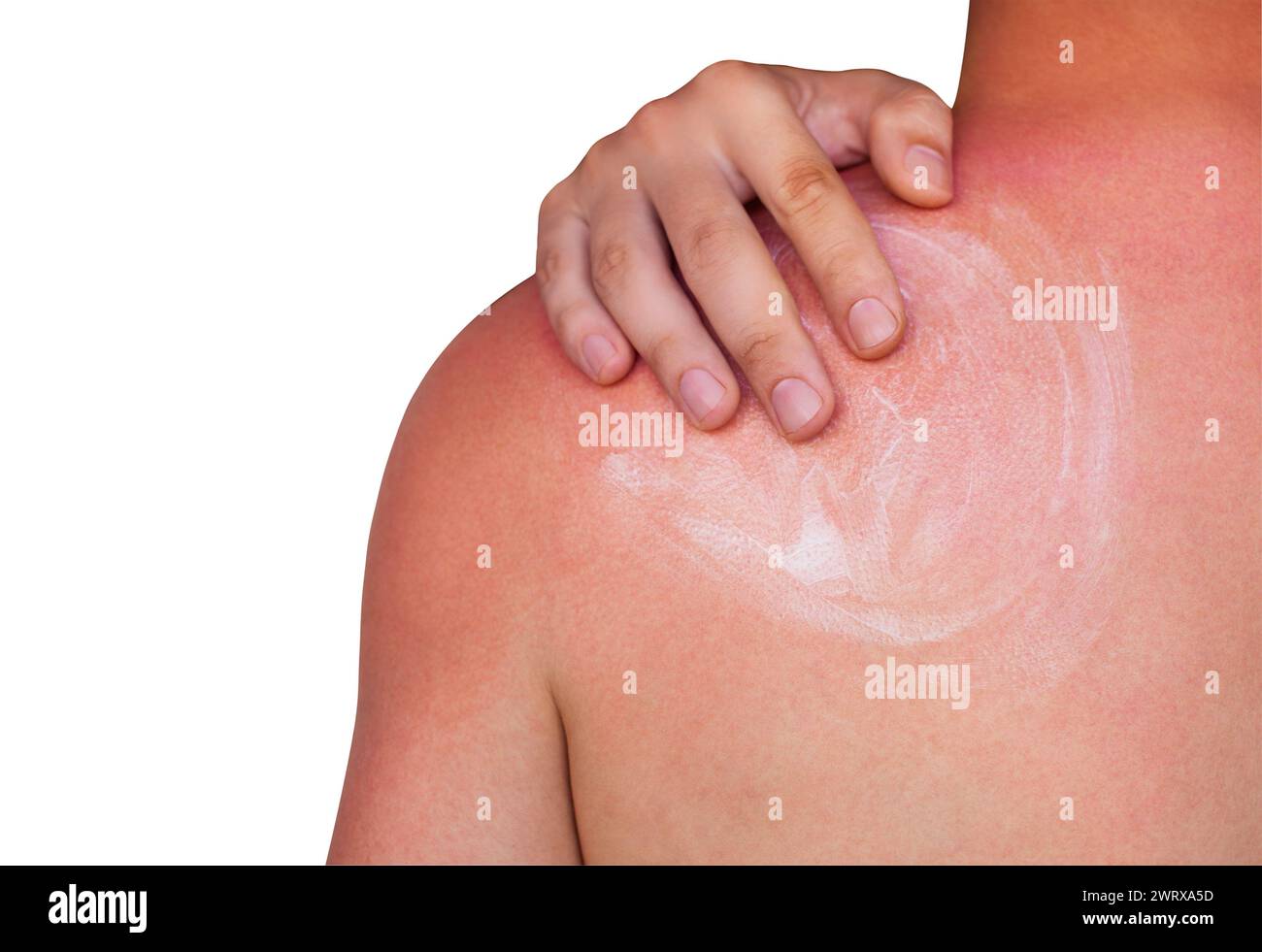 A man with reddened itchy skin after sunburn, smears cream on the skin
