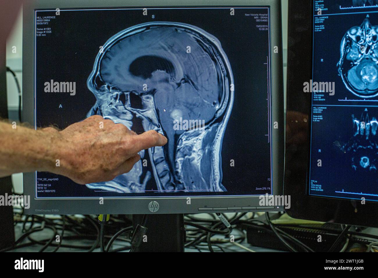 Neurosurgeon ponting  towards computer, analyse patient MRI Scan, Diagnose Brain. Brain Surgery Health Clinic Lab. Stock Photo