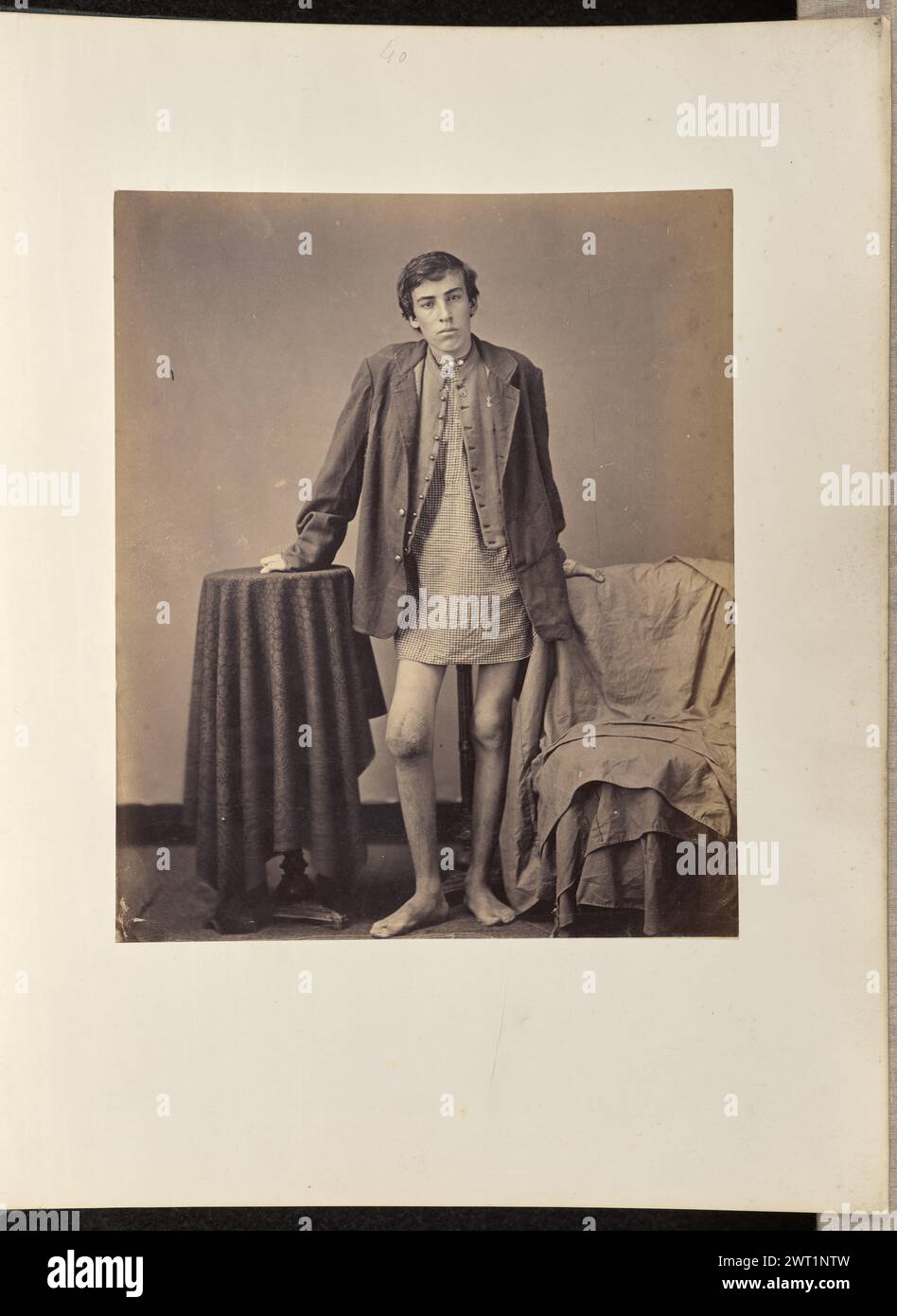 Recovery, without Amputation, after a Gunshot Wound through the Right Knee-joint. Possibly William H. Bell, photographer (American, 1830 - 1910) July 9, 1865 Portrait of Private Peter Stuck standing between a table covered with a dark cloth and a chair covered with a tarp. He rests his right hand on the table, his left on the back of the chair, and holds his right leg forward and bent slightly at the knee. He wears a checked shirt under an unbuttoned vest and jacket and no trousers. A scar is visible on his right knee. (Recto, mount) upper center, handwritten in pencil: '40' Lower center, hand Stock Photo