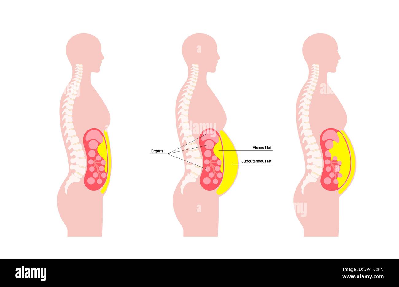 Visceral fat diagram, illustration. Belly fat surrounds internal organs ...