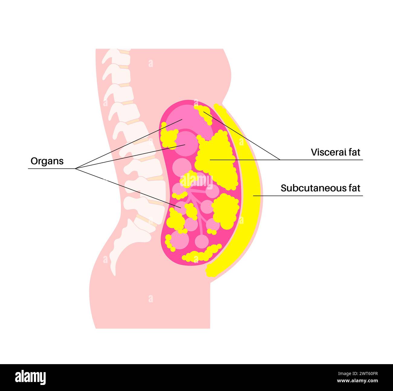 Visceral fat diagram, illustration. Belly fat surrounds internal organs ...