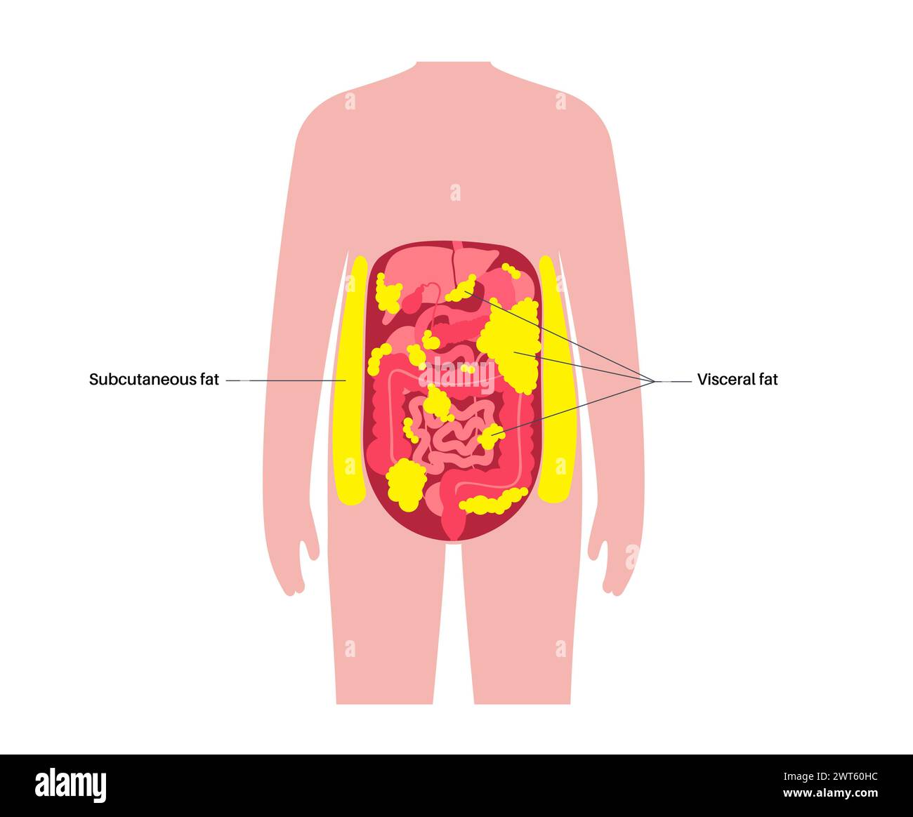 Visceral fat diagram, illustration. Belly fat surrounds internal organs ...
