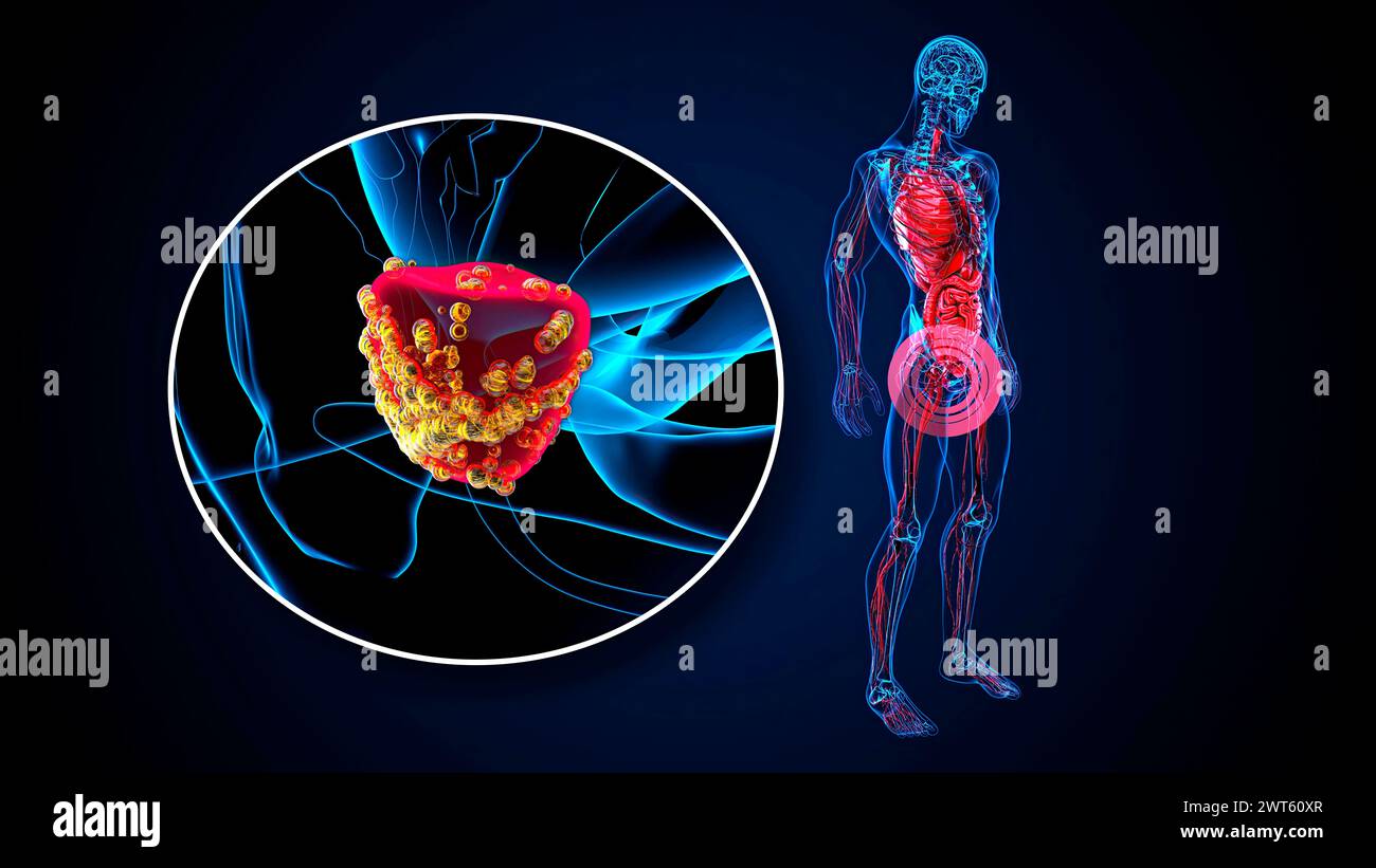 Prostate Cancer Backround Prostate cancer, conceptual illustration Stock Photo - Alamy