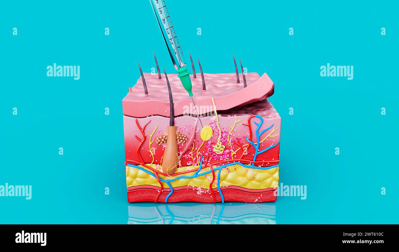 Illustration of an injection into the dermis of the skin Stock Photo ...