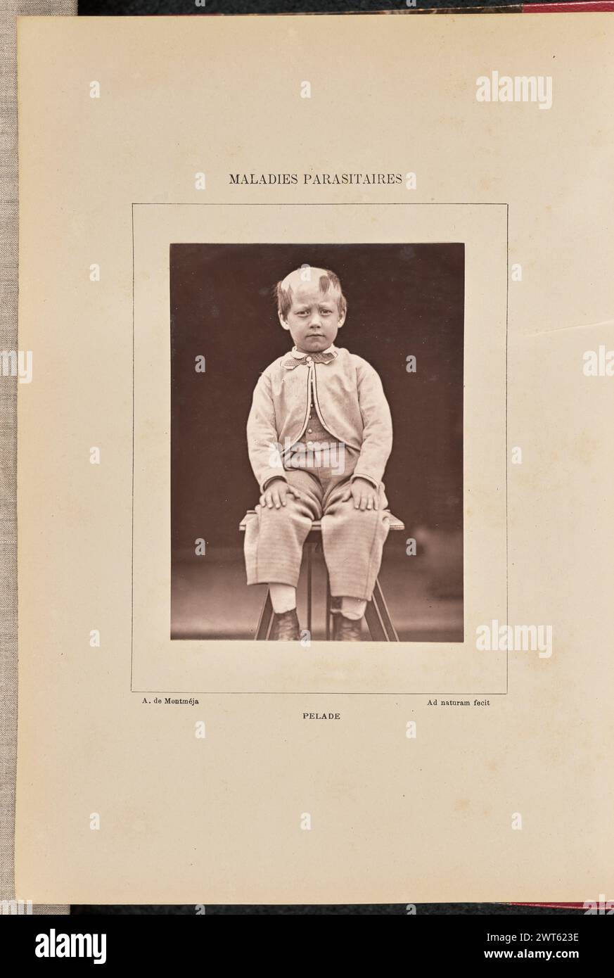 Pelade. Arthur de Montmeja, photographer (French, born 1841) negative about 1867, print 1882 Portrait of a young boy with alopecia areata sitting on a stool with his hands resting on his knees. (Recto, mount) upper center, printed in black ink: 'MALADIES PARASITAIRES' Lower left, printed in black ink: 'A. de Montmeja' Lower center, printed in black ink: 'PELADE' Lower right, printed in black ink: 'Ad naturam fecit' Stock Photo