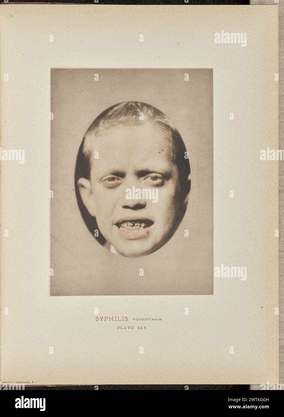 Syphilis hereditaria. Dr. George Henry Fox, photographer (American ...