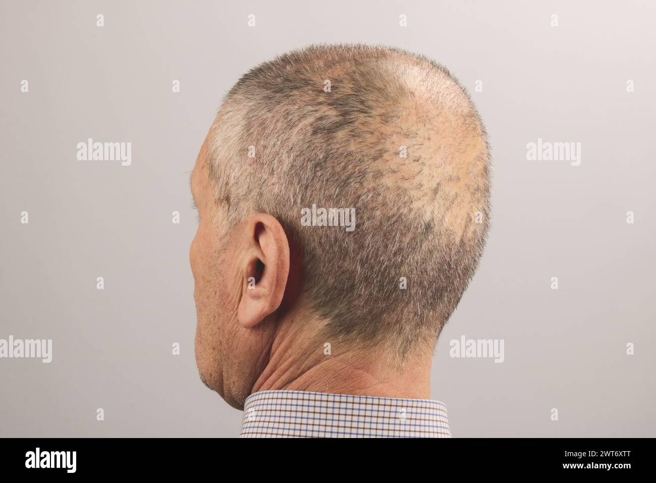 view of a man's head with hair transplant surgery area, two week after the transplant Stock Photo