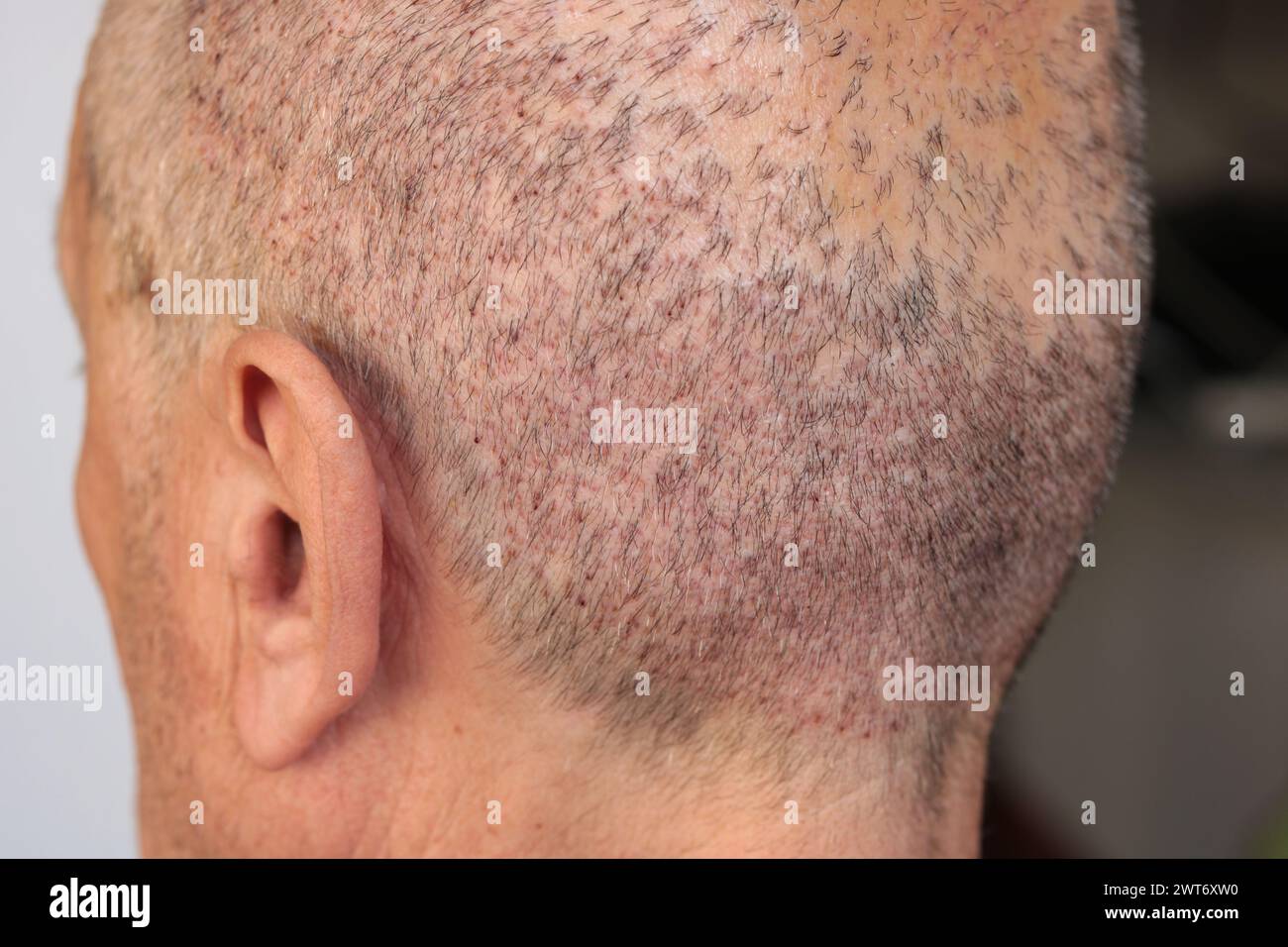 view of a man's head with hair transplant surgery area, one week after the transplant Stock Photo