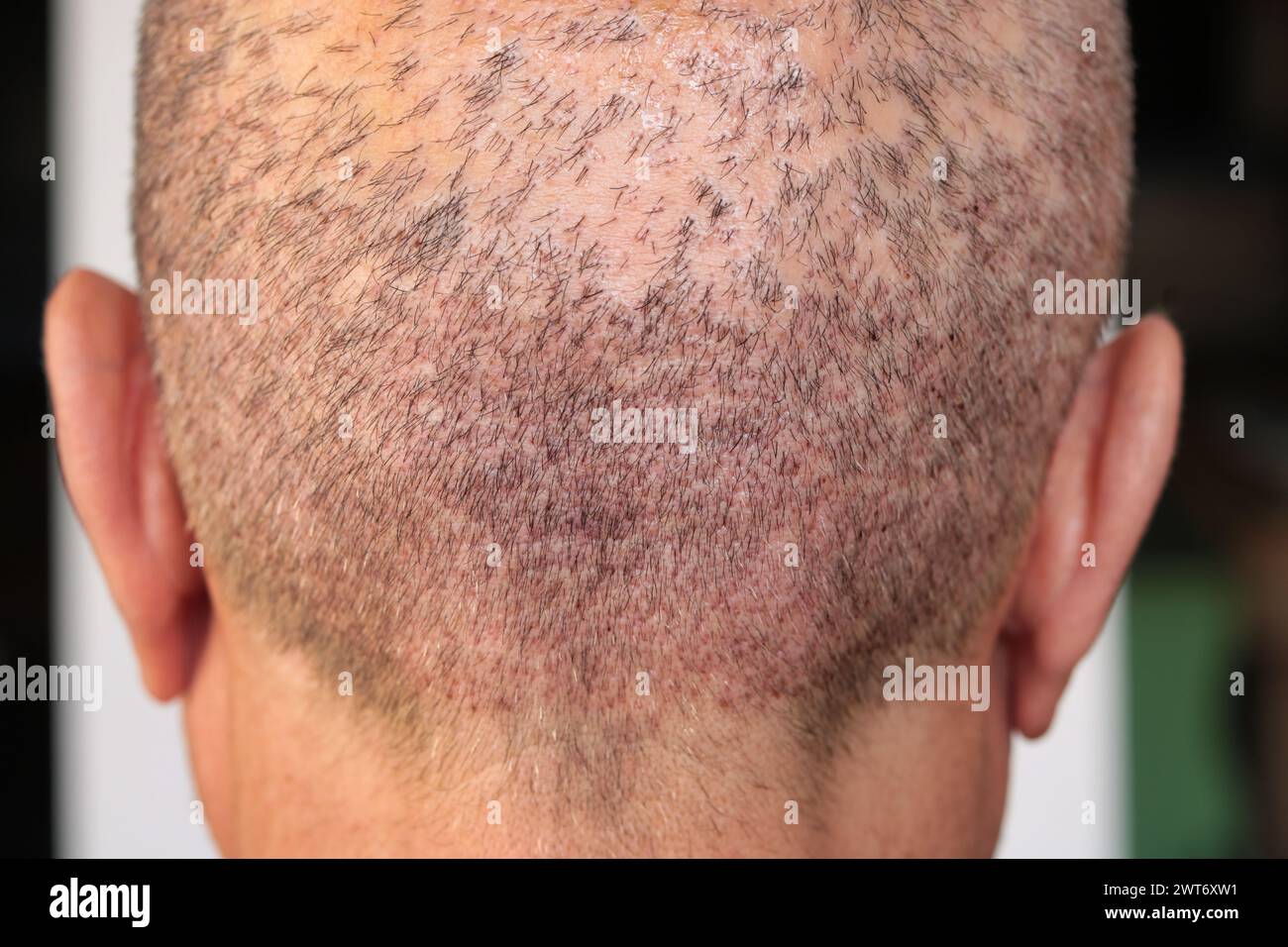 back view of a man's head with hair transplant surgery area, one week after the transplant Stock Photo
