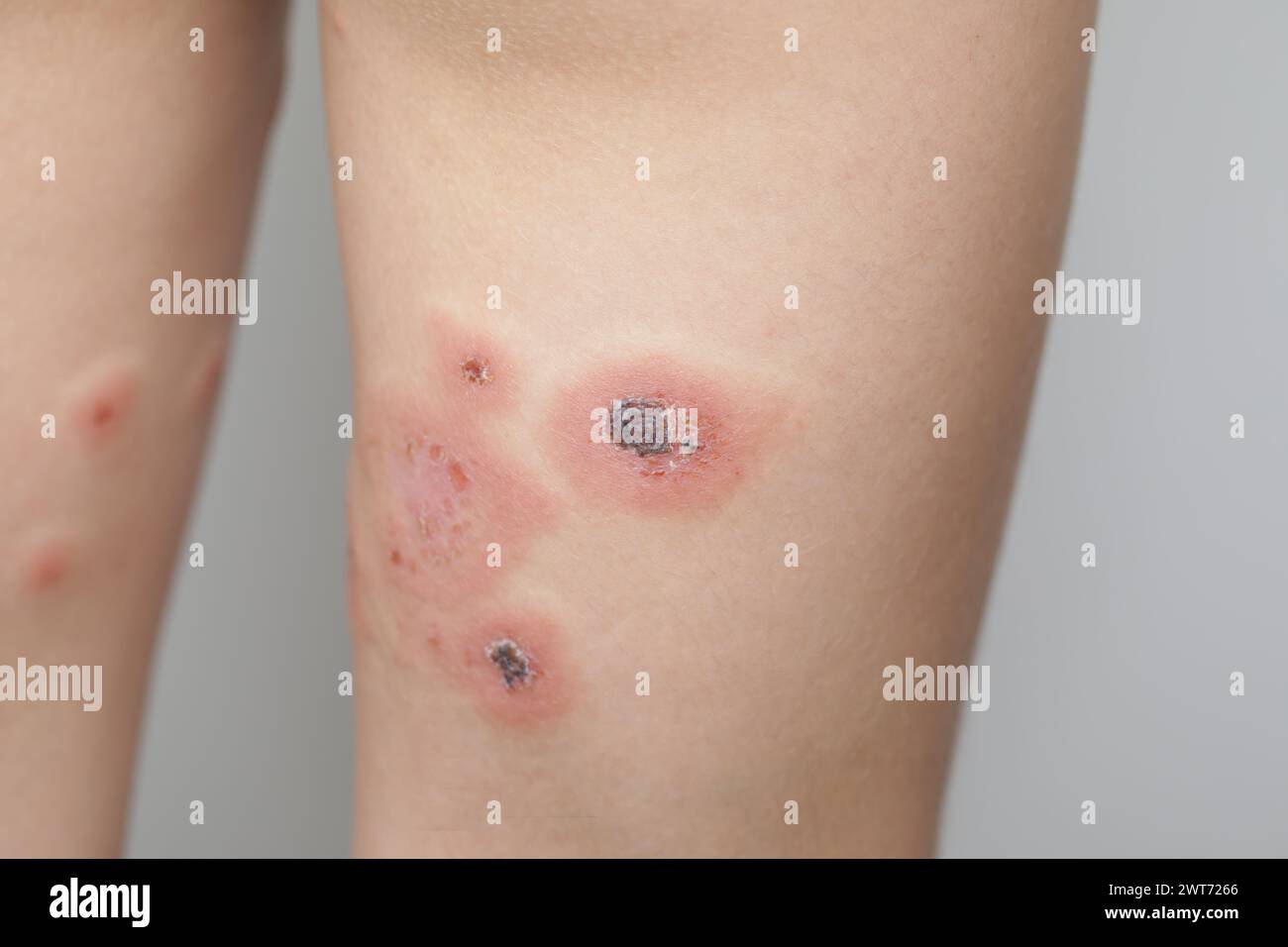 Female leg closeup.  Body with skin problem. Infectious disease. Allergy, dermatitis, virus or bacterial infection. Dermatology,  medicine and health Stock Photo