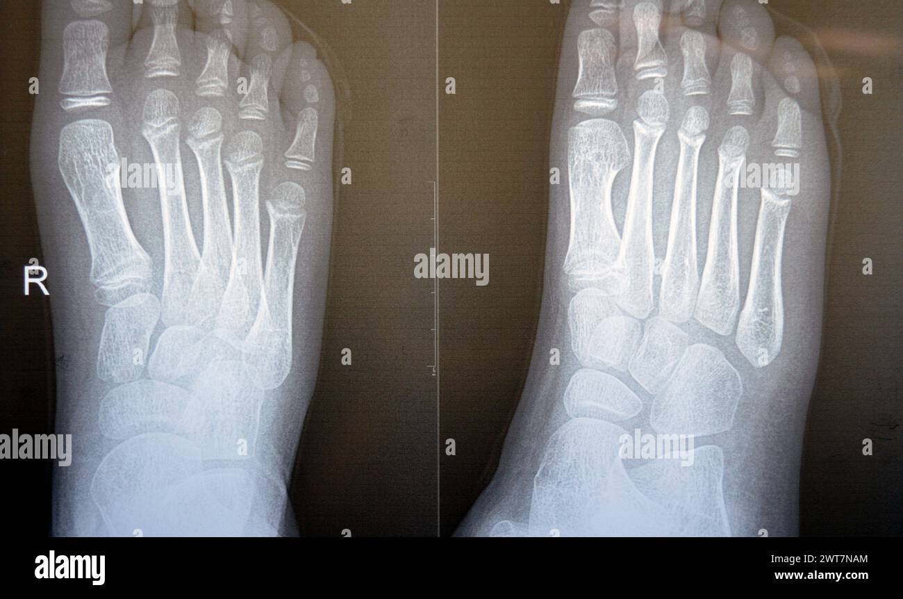 Plain x ray of the right foot of a 9 years old child shows normal pediatric bone xray study, with ossification centers of a normal growing child with Stock Photo