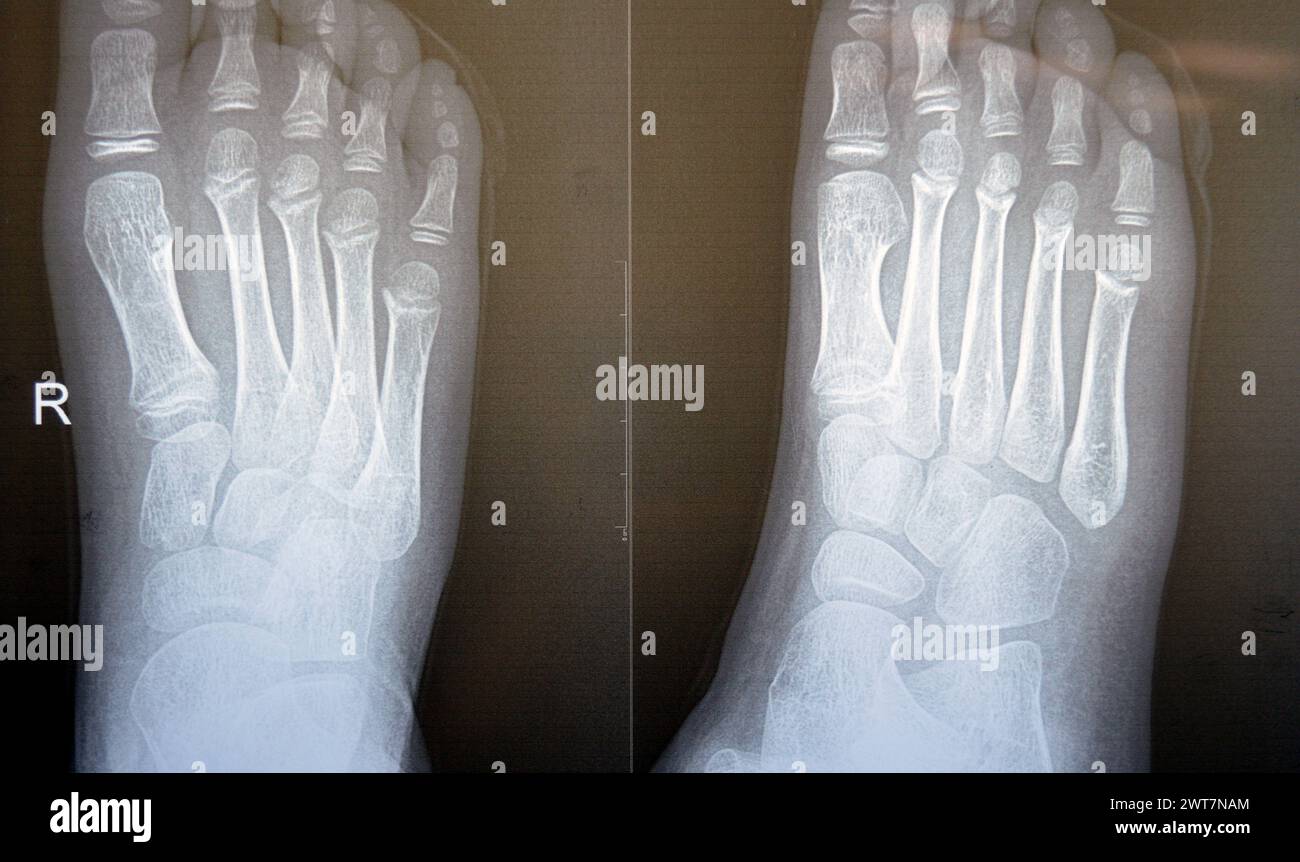normal-pediatric-ankle-xray
