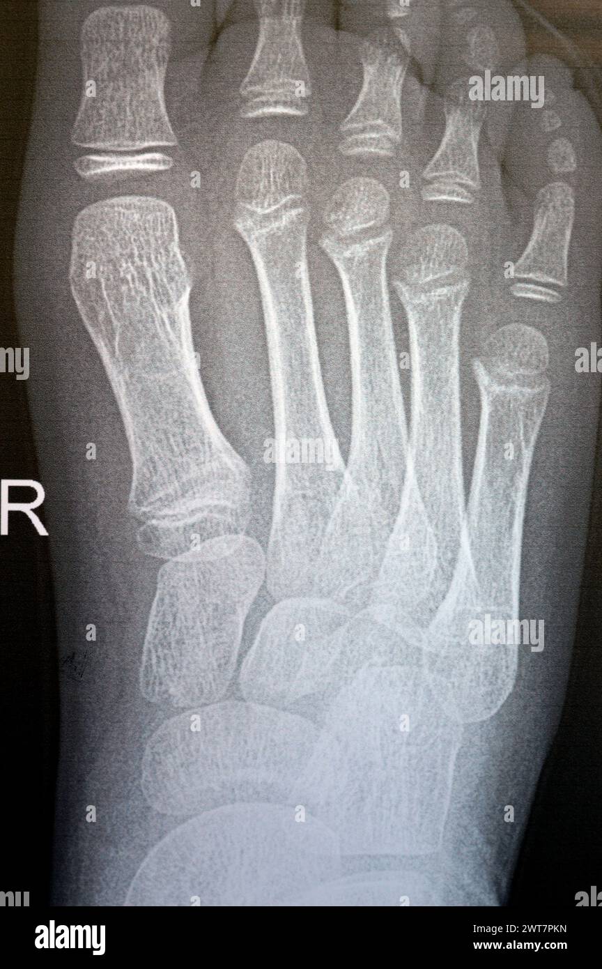 Plain x ray of the right foot of a 9 years old child shows normal pediatric bone xray study, with ossification centers of a normal growing child with Stock Photo