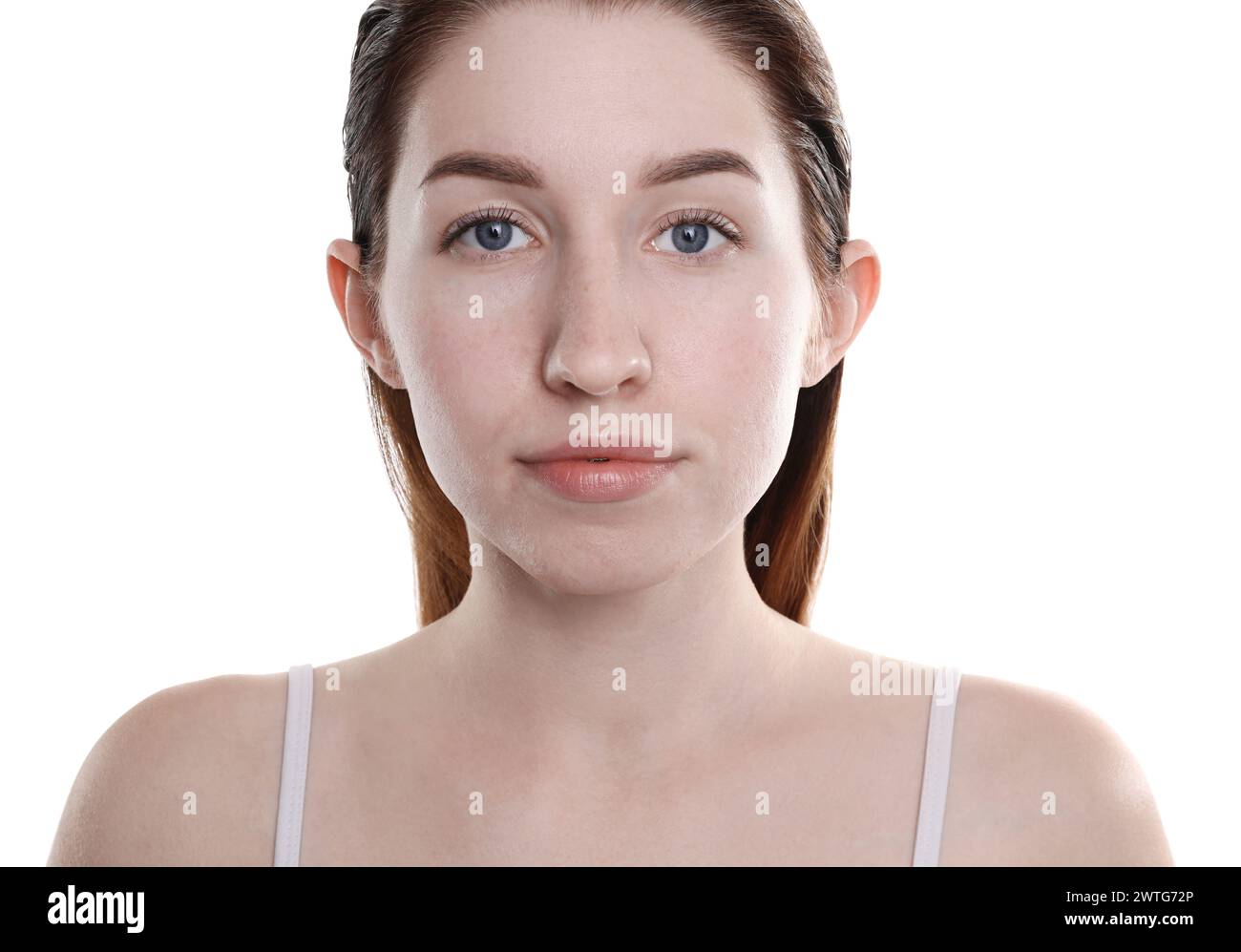 Young woman with acne problem on white background Stock Photo